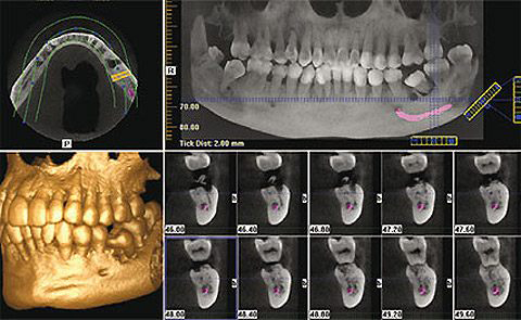 歯科用CT（KaVo 3D eXam）