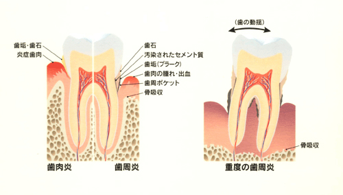 歯周病の原因